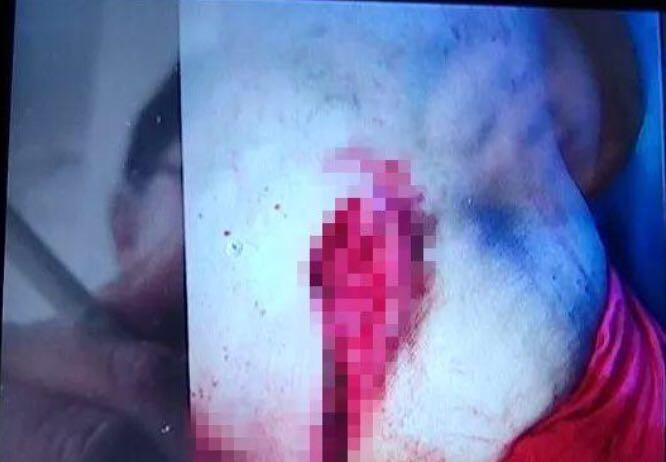 被猪咬了没有出血要打狂犬疫苗吗,猪咬着还打狂犬疫苗吗