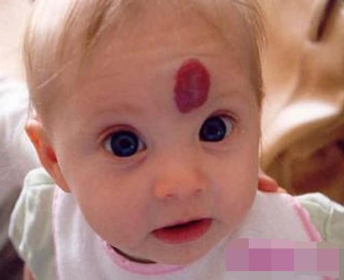 红胎记好治吗治疗红胎记的方法,宝宝有红胎记是怎么回事