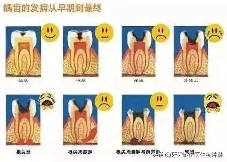洗牙会导致牙缝变大吗动画视频,洗牙会导致牙缝变宽吗