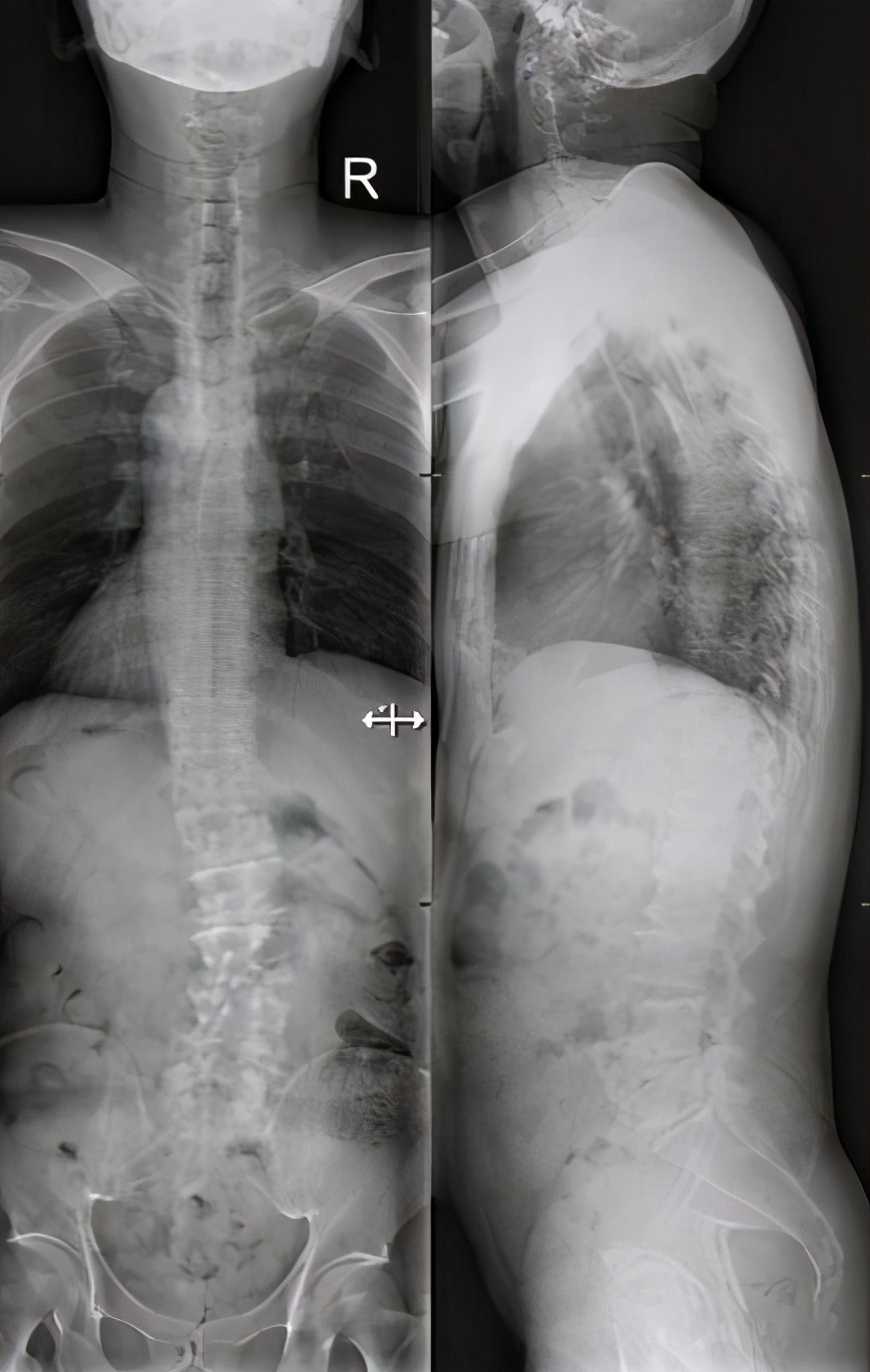 老年人腰椎侧弯最好的恢复方法,中年腰椎侧弯退变后果严重吗