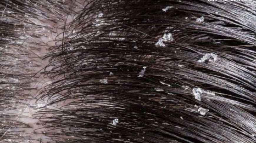 头皮长痘痘什么原因,头皮里面长痘痘是什么原因呢