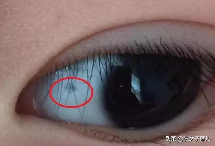 4岁宝宝眼白有黑点是怎么回事,三岁宝宝眼白有黑线是怎么回事