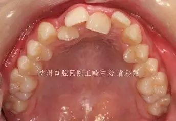 牙齿深覆合对脸型的影响,覆合型牙齿是怎么造成的