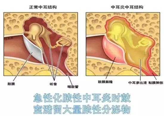 治疗急性中耳炎的药物,急性分泌性中耳炎症状