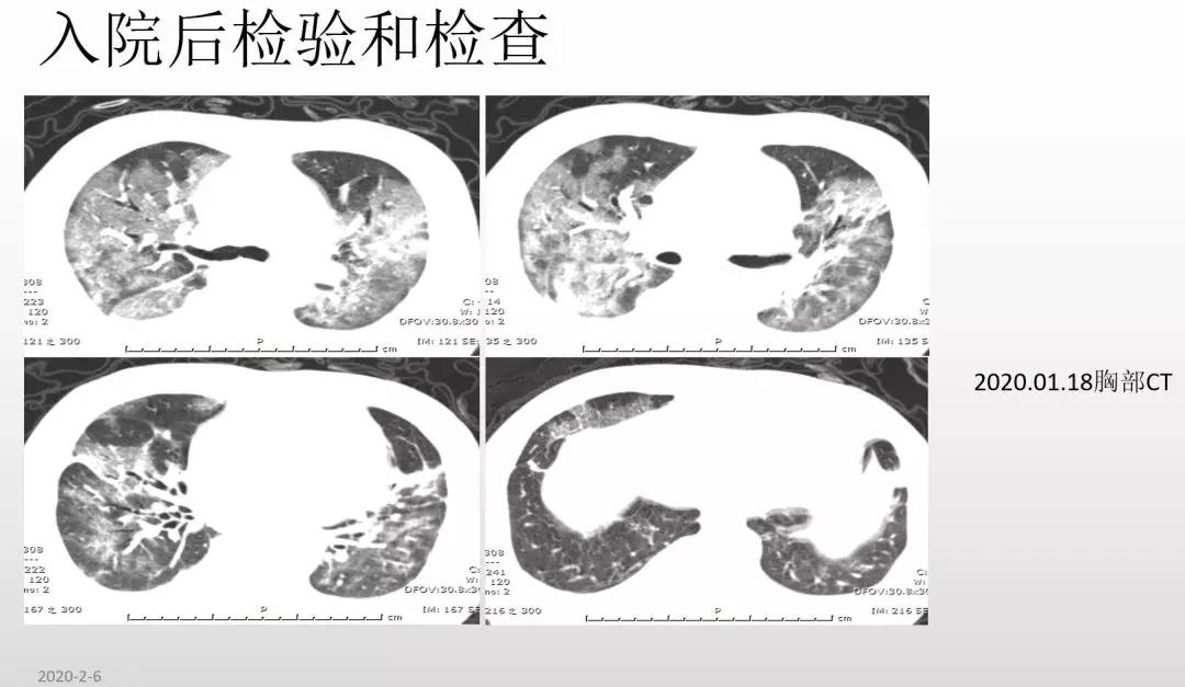 赵建平：重症CAP存在过度炎症反应时合理应用激素可减轻