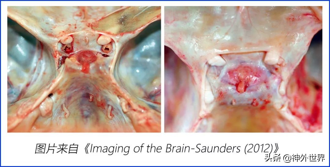 鞍区核磁解剖图,鞍区解剖与手术
