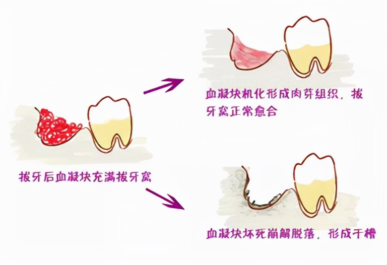 拔牙干槽症几天能治愈,干槽症不处理牙窝会愈合吗