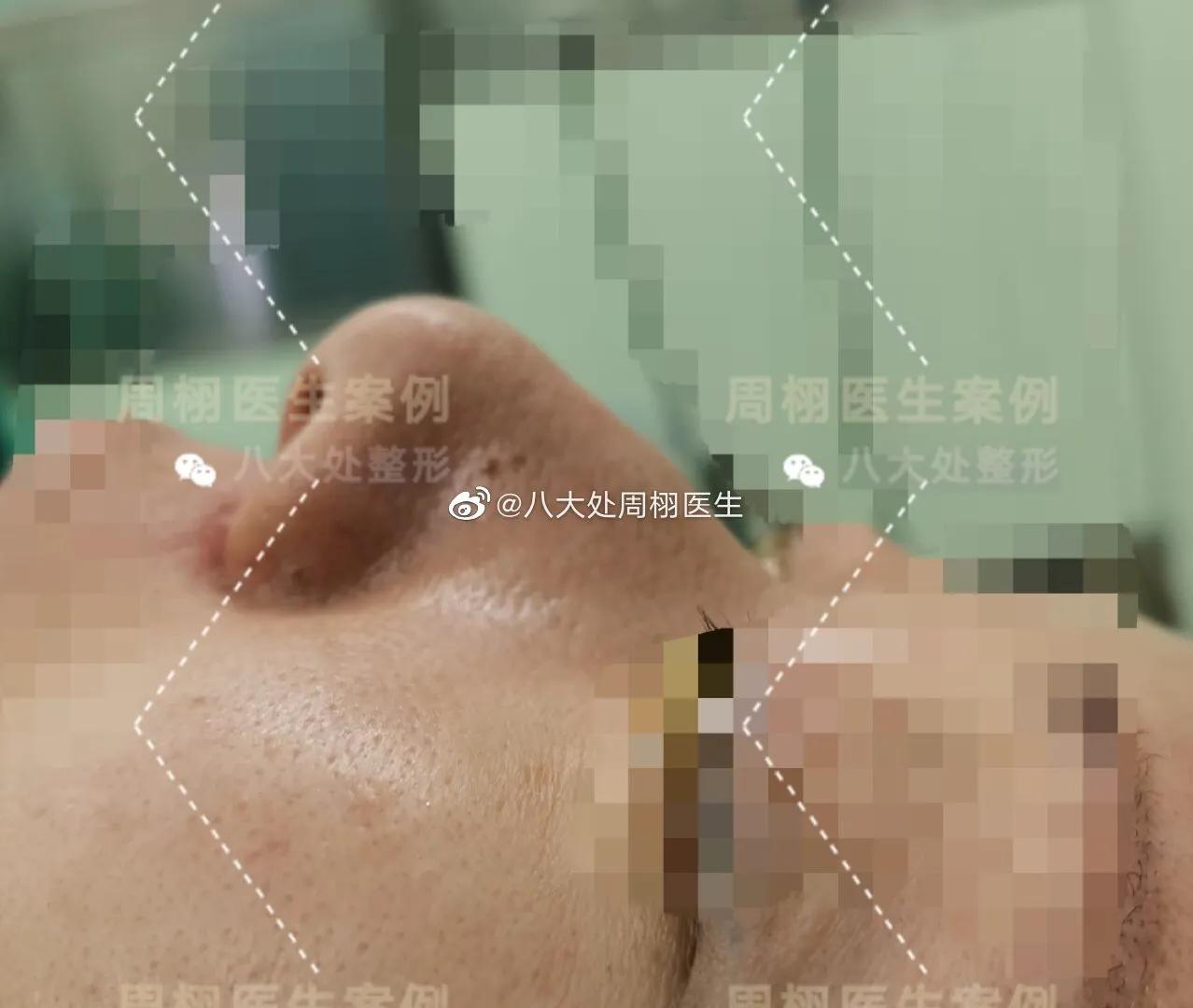 鼻整形手术,鼻整形术