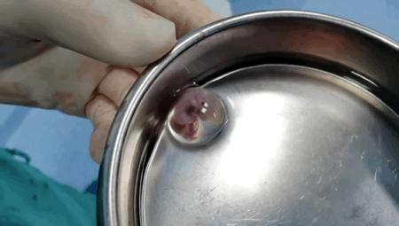 月经淋漓不尽突然大出血啥原因,来月经小腹疼得厉害是不是宫外孕