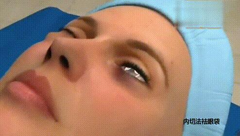 祛眼袋术后脸肿得很厉害怎么办,祛眼袋术后多久可以做皮秒