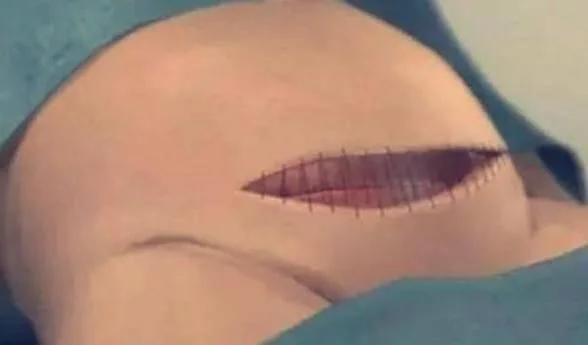 剖腹产仅仅“挨一刀”就完事了？看完四张图，谁说简单和谁急