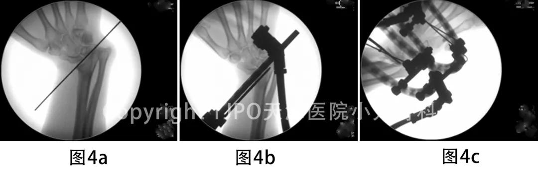 桡骨小头畸形截骨矫形,小儿尺桡骨远端发育迟缓畸形