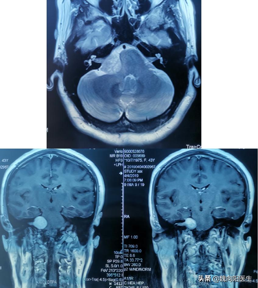 耳眩晕是什么疾病,眩晕常见疾病之梅尼埃