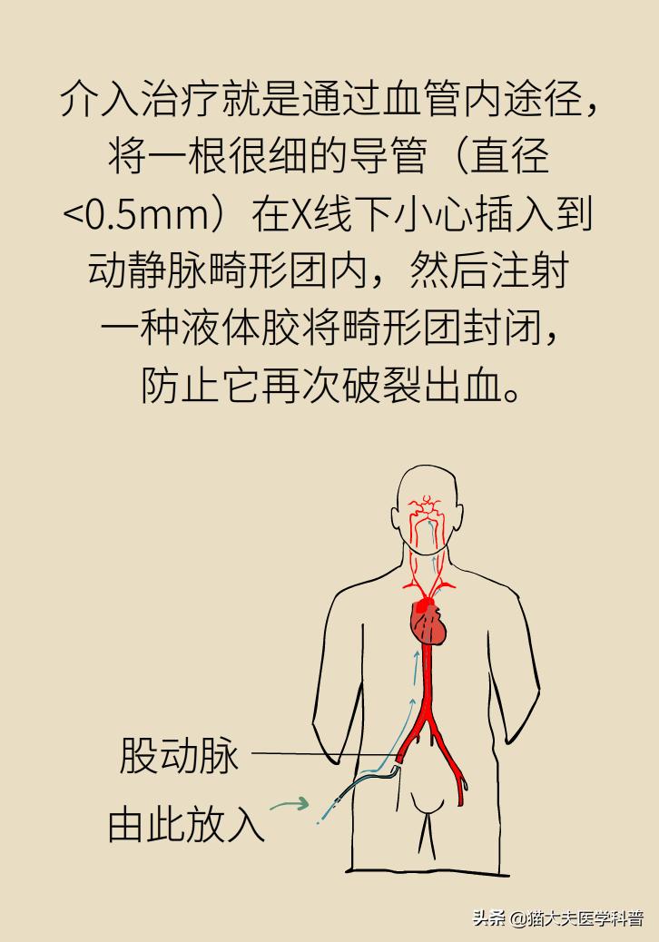 脑血管畸形在哪些部位比较严重,先天性脑血管畸形可以治愈吗