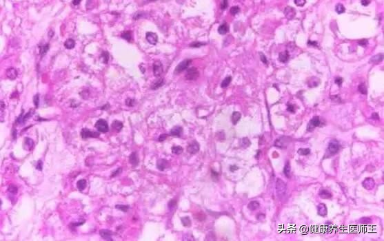 外阴良性肿瘤需要动手术吗,外阴良性肿瘤切除术