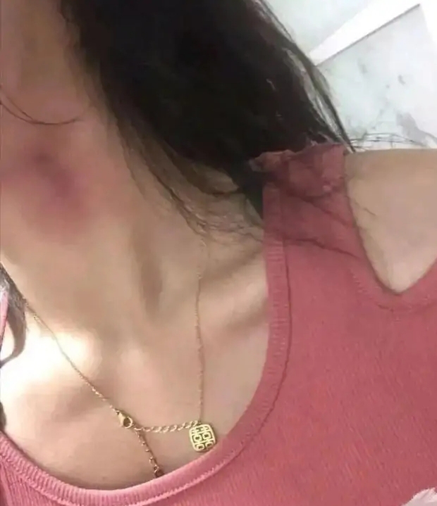发现女友身上有吻痕该怎么办,女友颈部有吻痕