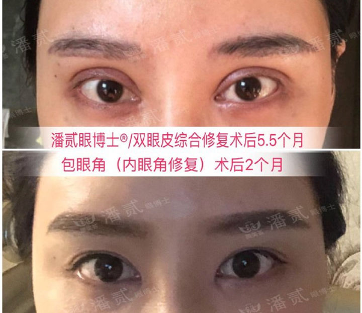 开眼角手术如何避免回缩,开眼角手术常见问题及解决方法