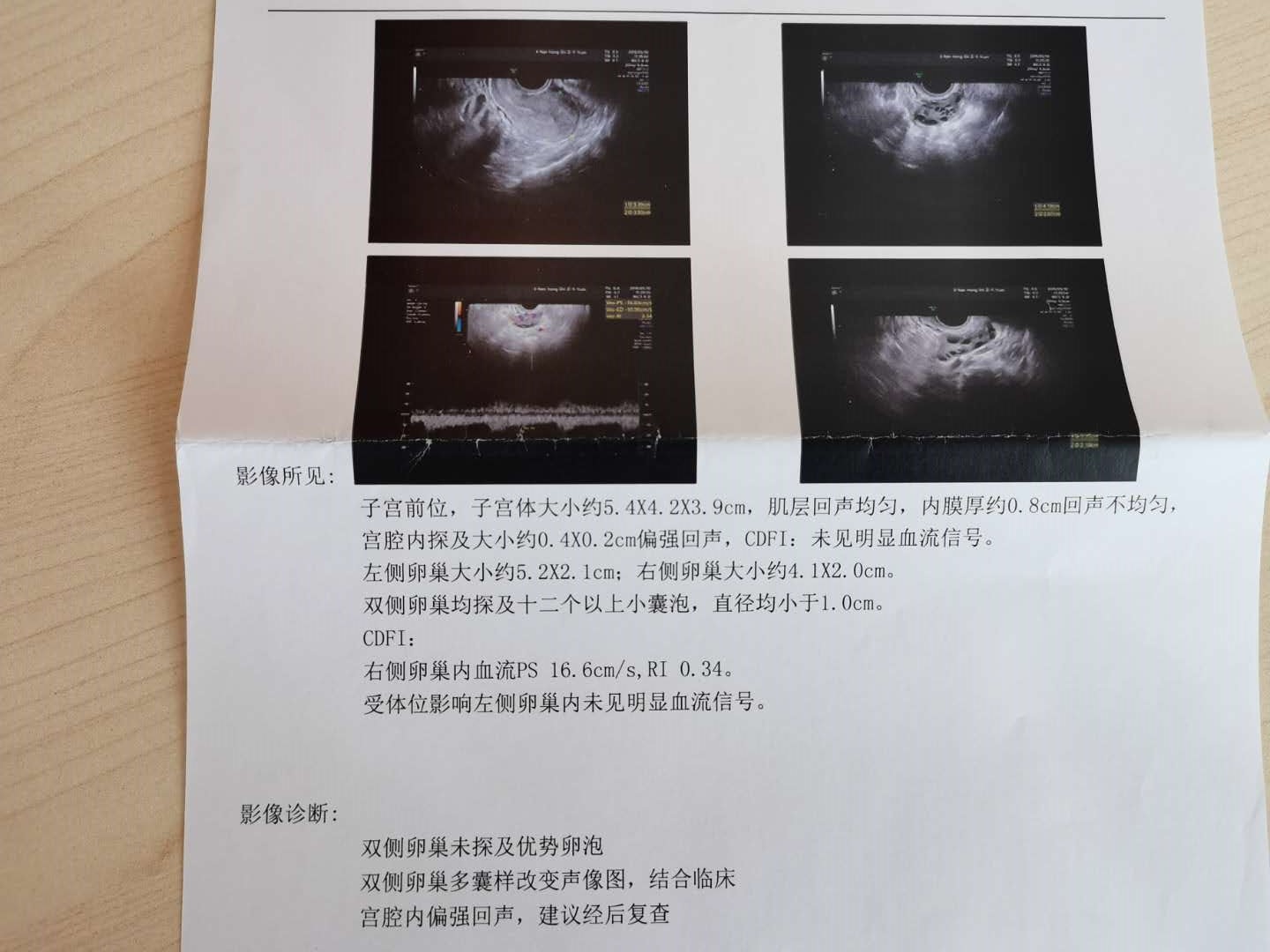 如何判断是多囊引起的肥胖,是多囊导致的胖还是胖导致的多囊