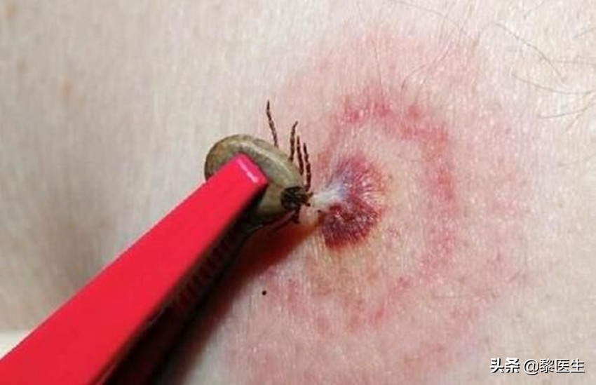 被蜱虫咬了后进icu多久可以恢复,男子被蜱虫咬后进了icu