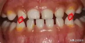 地包天早期矫正最佳时间,地包天最佳矫正时间及方法