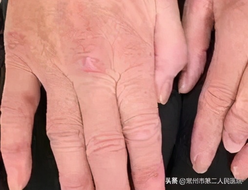 得了皮肌炎，挂号是挂皮肤科？