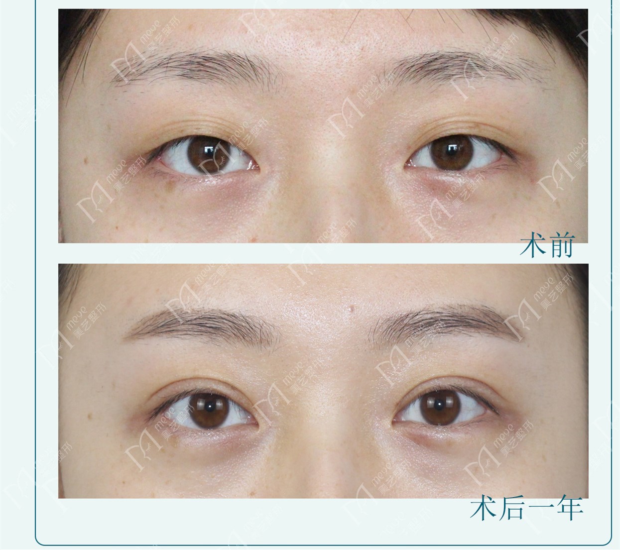 三眼皮和双眼皮哪个好看,三眼皮和二眼皮好看吗