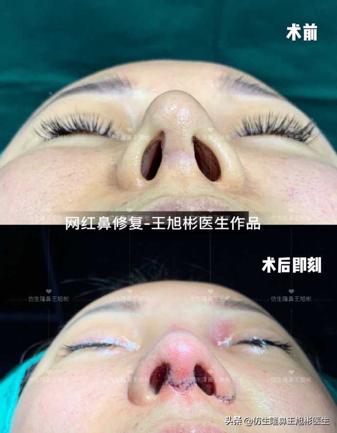 鼻中隔重塑鼻头,鼻中隔重建整形