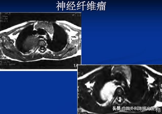 后纵隔恶性肿瘤怎么样,后纵隔占位肿瘤几率大吗