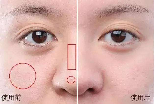 解决黑头的2种药,解决黑头的最好方法