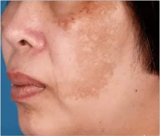 去除淡褐斑的小妙招,去除斑点暗黄修复肌肤