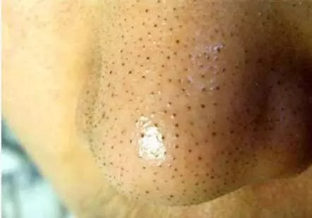 用手挤黑头谨慎变成草莓鼻，每天用这两样东西搓，黑头很快消失