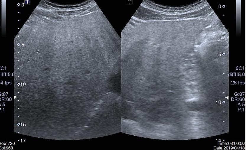 有脂肪肝早上能空腹跑步吗,减脂肪肝是跳绳好还是跑步好