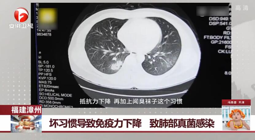 死亡率高达50%的病毒,中国有多少人感染超级真菌