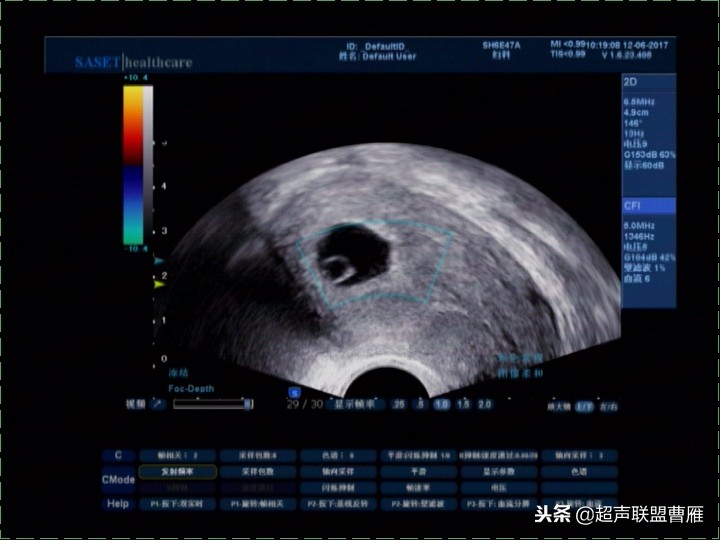 内见卵黄囊,卵黄囊肿瘤