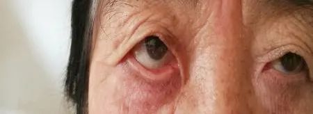 眼整形修复权威科普,科普眼整形手术是个什么手术多图