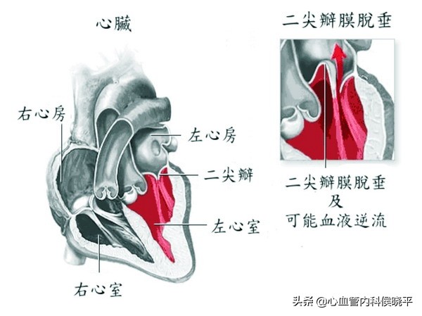 二尖瓣反流三尖瓣反流的原因,二尖瓣三尖瓣反流是心脏瓣膜病吗