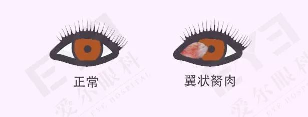 眼睛白眼睛上长肉是什么原因,眼睛白上长肉是怎么回事