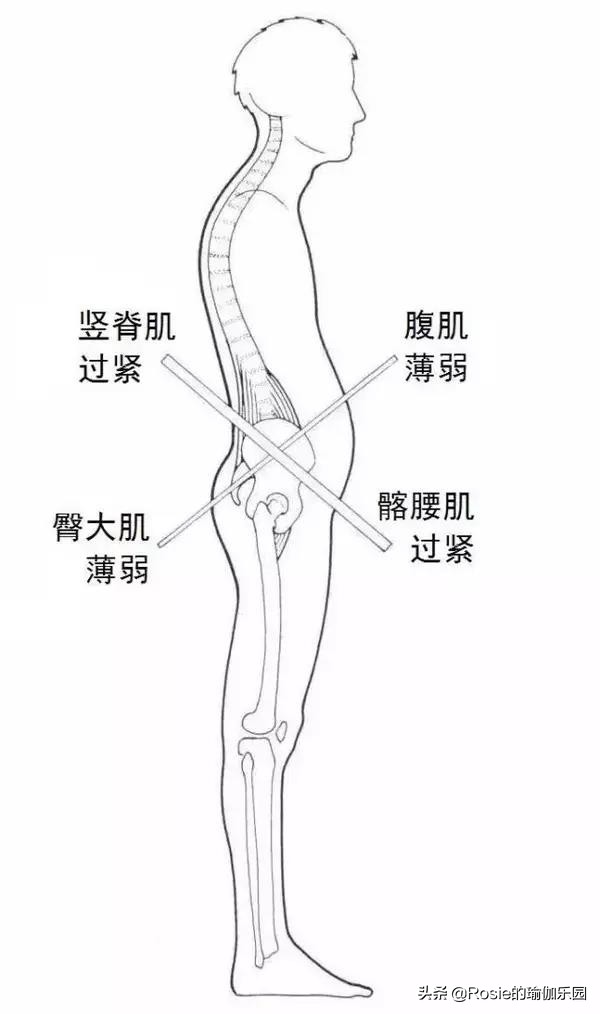 “翘臀”还有假？先自测再确认：你是真“翘臀”还是骨盆前倾？