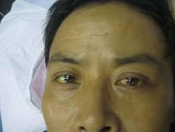 阻塞性黄疸怎么保守治疗,阻塞性黄疸凝血功能下降