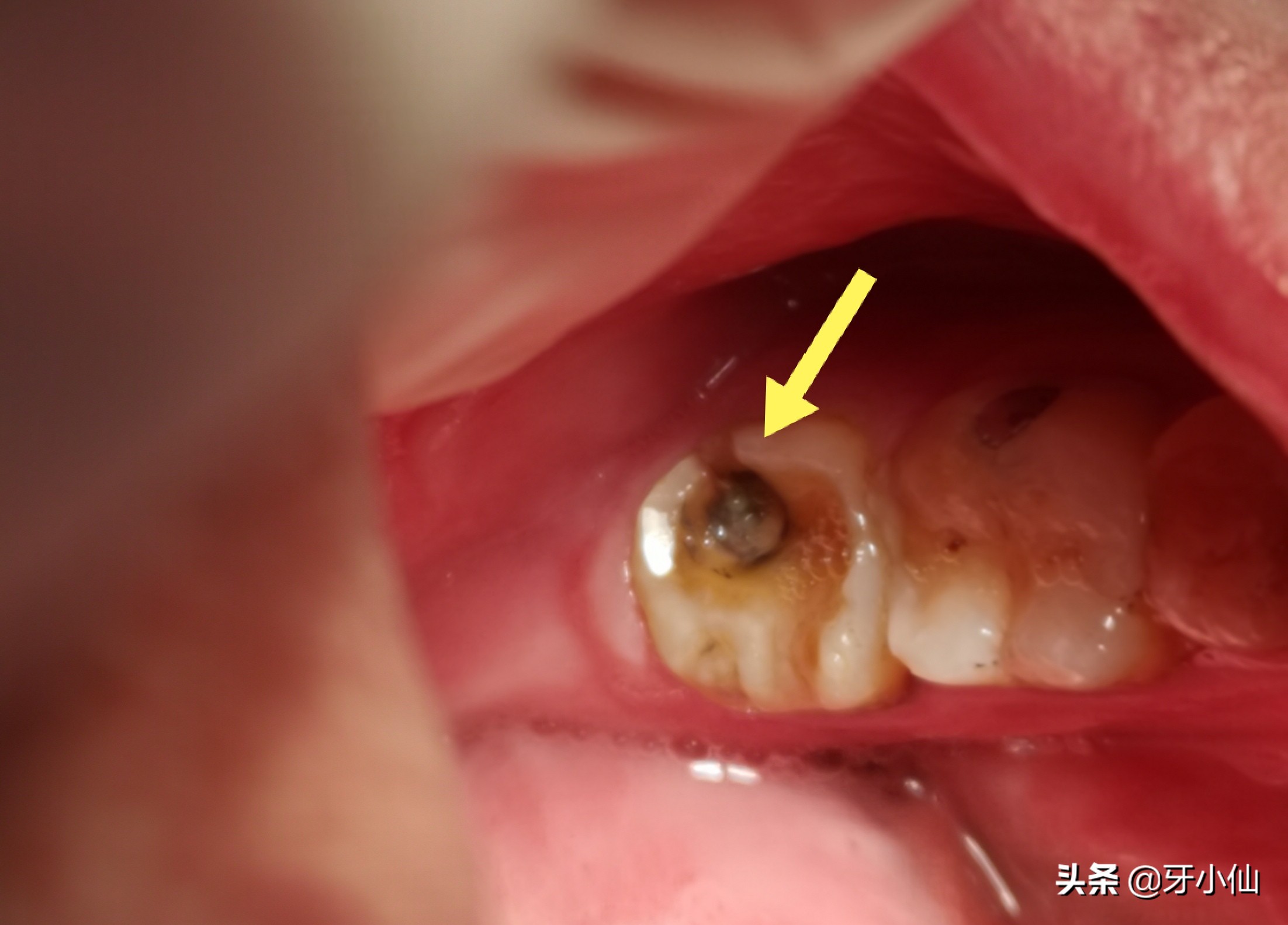 牙太痛，吃不了热辣火锅、冰爽雪糕、酸甜水果，怎么能当吃货？