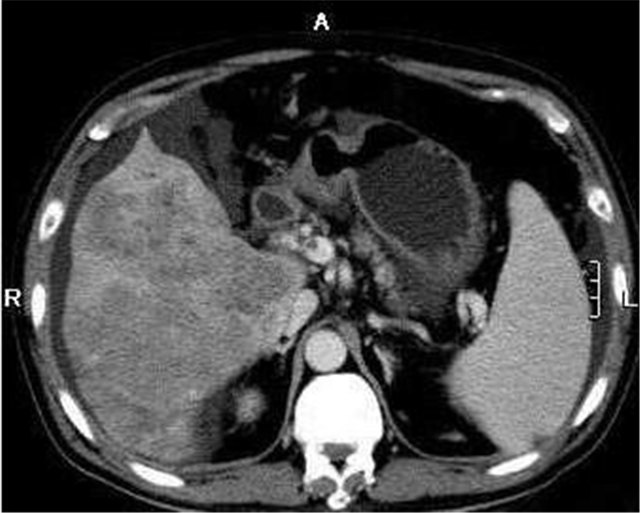 晚期肝癌常见的并发症,肝癌身体有什么前兆