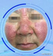 拯救酒糟鼻、脚气、灰指甲、疥疮，最简单便宜的方法！