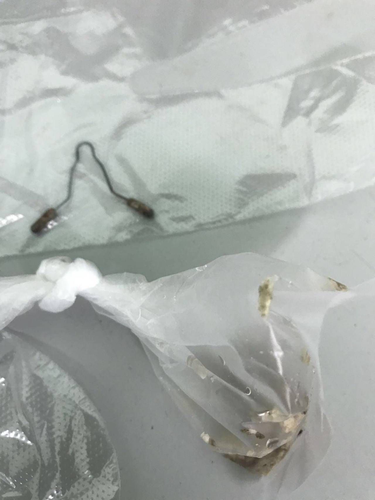 女子患上结石被告知要切肾,女子发现结石