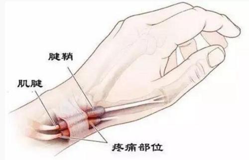 几个动作预防腱鞘炎（妈妈手），准妈妈必看