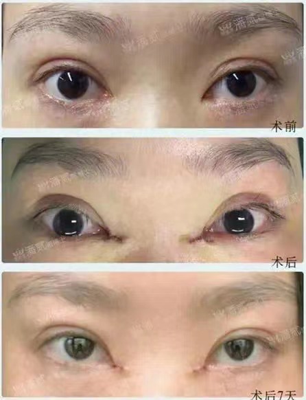 开内眼角会留疤的照片,开内眼角的疤痕变白色了怎么办