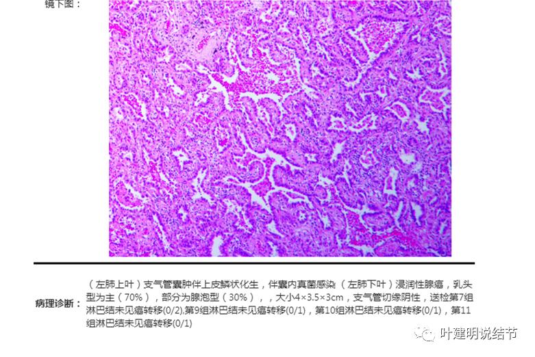 左肺癌手术半年右肺下角还有炎症,左下肺癌晚期