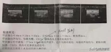 体检查出甲状腺结节该咋办,体检有甲状腺结节医生说没事