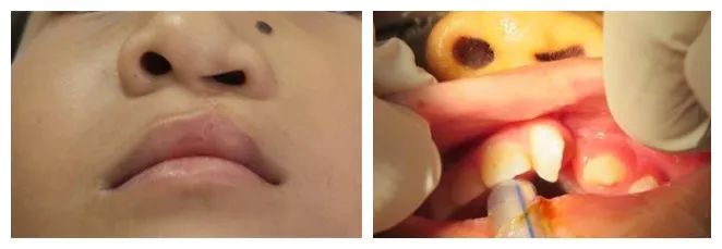 唇腭裂宝宝术后怎么处理,唇腭裂为什么牙齿不整齐