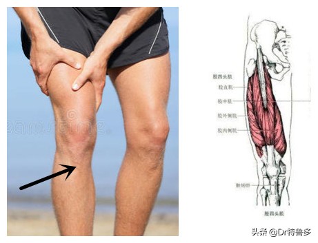 胫骨结节炎和生长痛区别,膝盖胫骨结节痛怎么治