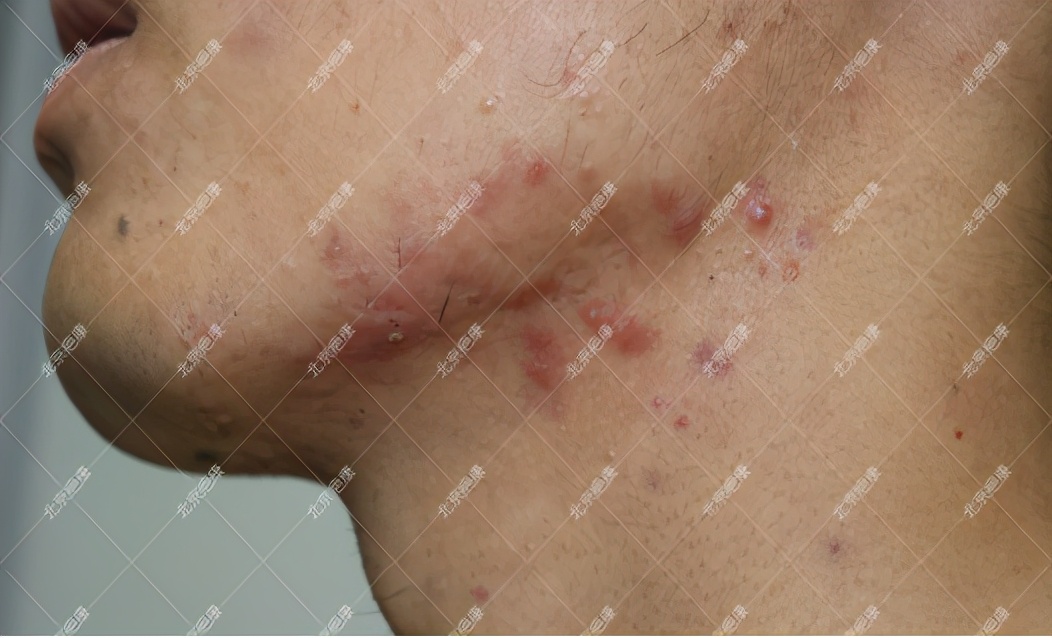 疤康治疤痕疙瘩靠谱吗,瘢痕疙瘩用疤克管用吗